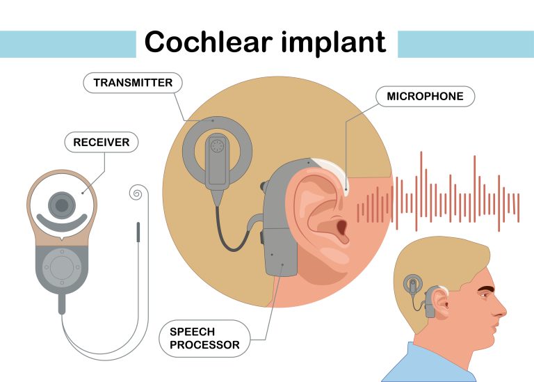 Cochlear implant device electrically stimulates nerve medical aid ear sound wave adults hard middle exam. Modern vector illustration in flat style