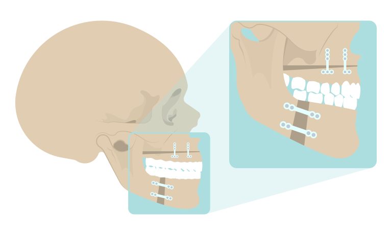 Maxillomandibular Advancement (MMA), jaw repositioning